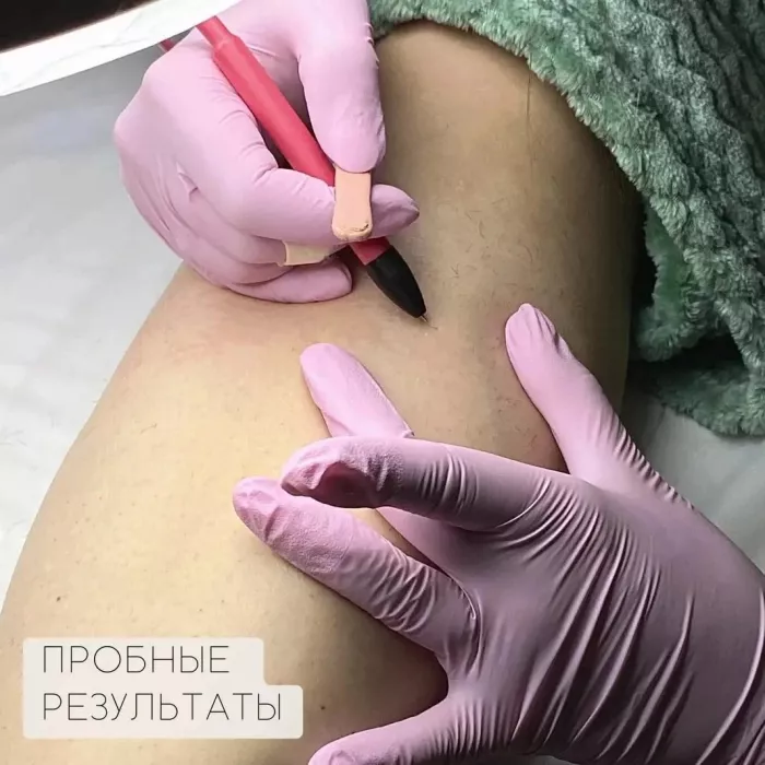 Электроэпиляция "Epil Beauty".